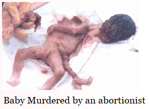 Aborted unborn baby