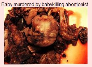 Baby Murdered by abortionist