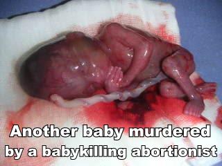 Baby killed by aborrtion