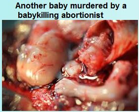 Baby killed by an abortionist